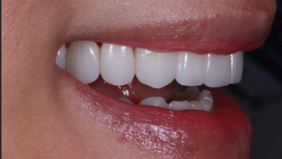 Dr.Goodman Bite Correction | Top Beverly Hills Dentist in LA